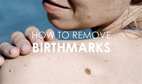 What do birthmarks tell you?