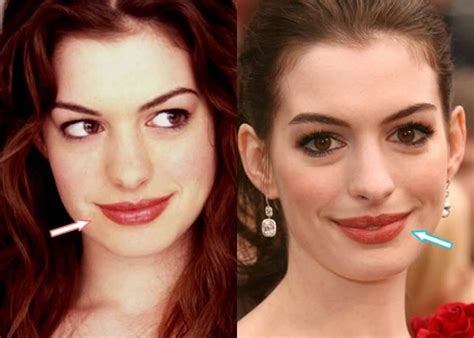 What do celebrities do instead of Botox?