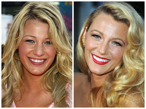 What do celebrities use for white teeth?