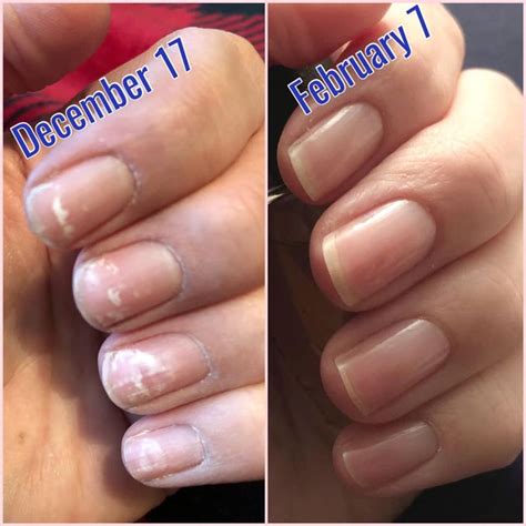 What do dehydrated nails look like?