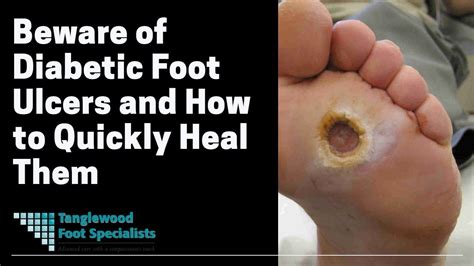 What do diabetic feet look like?