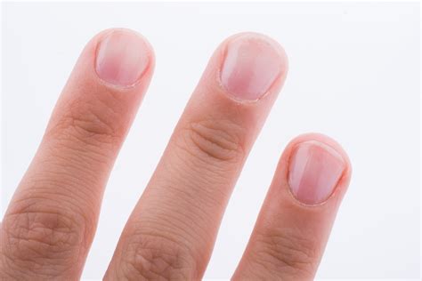 What do diabetic fingernails look like?