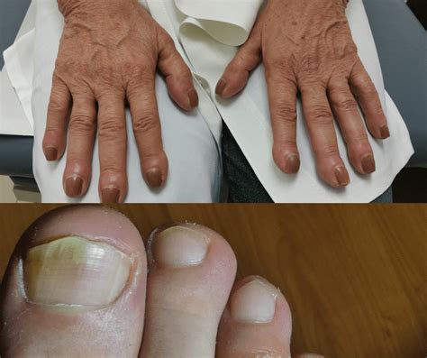 What do fingernails look like with kidney disease?