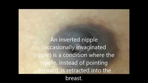 What do flat nipples look like?