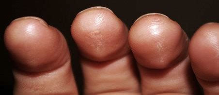 What do healthy guitar calluses look like?