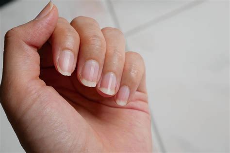 What do iron deficiency nails look like?
