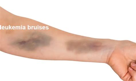 What do leukemia bruises look like?