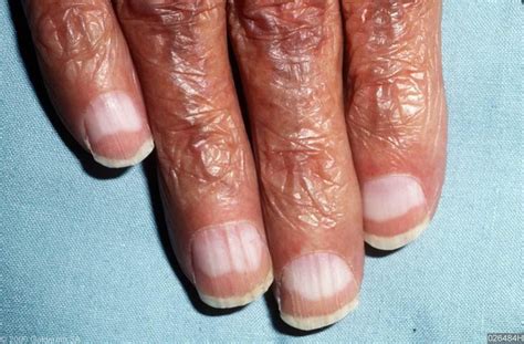 What do liver failure nails look like?