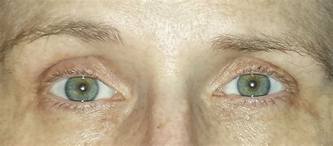 What do manic eyes look like?
