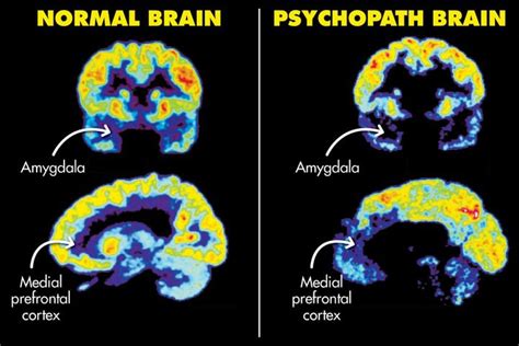 What do psychopaths miss in their brain?