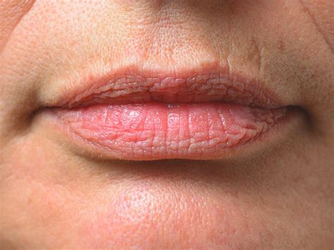 What do smokers lips look like?
