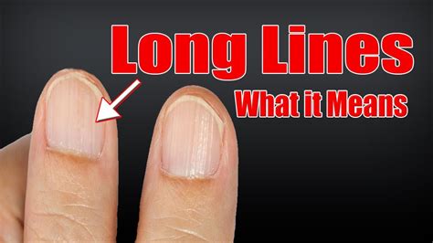 What do the lines on your nails mean?