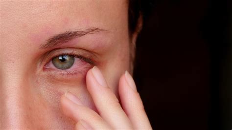 What do traumatized eyes look like?
