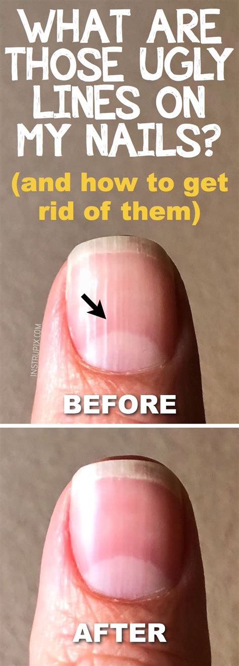 What do vertical lines on fingernails mean?