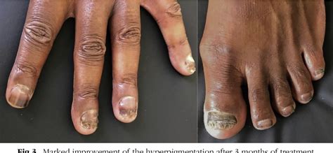 What does B12 deficiency nails look like?