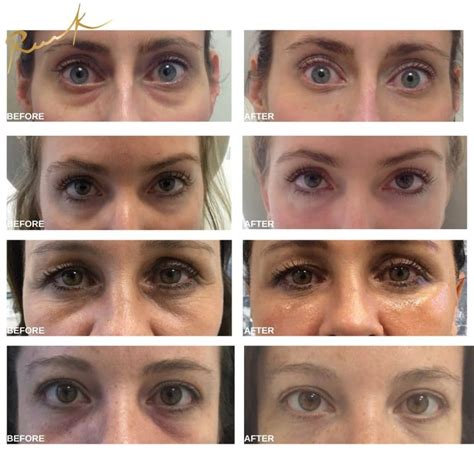 What does Botox under eyes do?