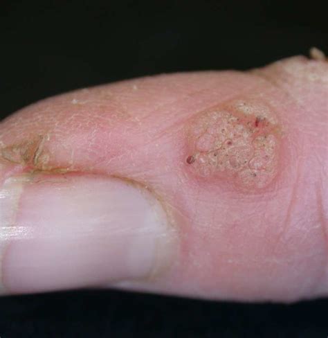 What does HPV look like on hands?