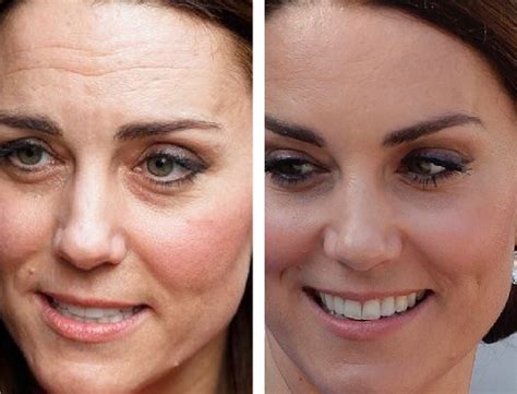 What does Kate Middleton use for wrinkles?