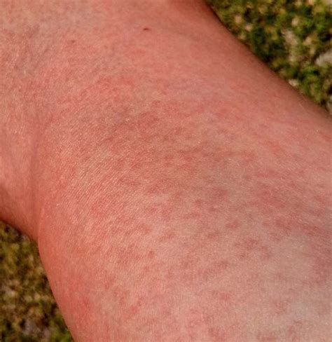 What does MS rash look like?