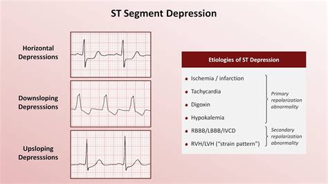 What does ST depression look like?