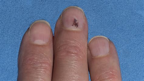 What does Stage 1 nail melanoma look like?