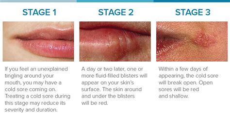 What does Stage 1 of a cold sore look like?