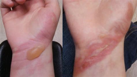 What does a 1st degree burn look like?