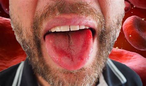 What does a B12 tongue look like?