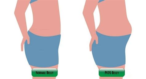 What does a PCOS belly look like?