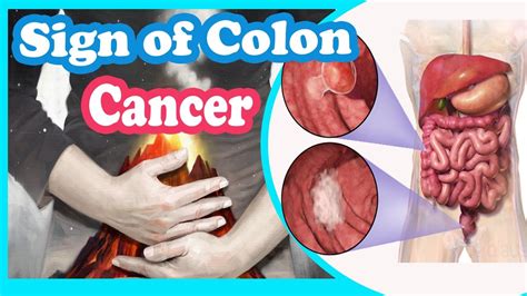 What does a bad colon feel like?