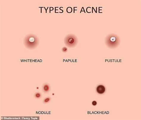 What does a black pimple mean?