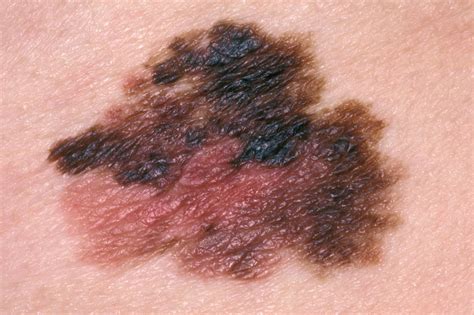 What does a blue melanoma look like?