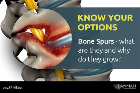 What does a bone spur look like on your gums?