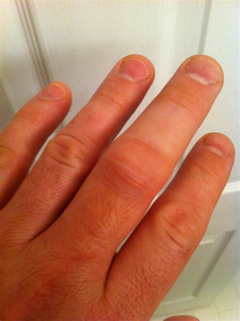 What does a broken finger look like?