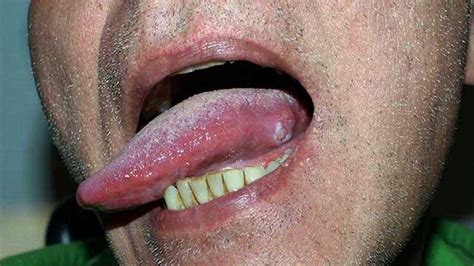 What does a damaged tongue look like?