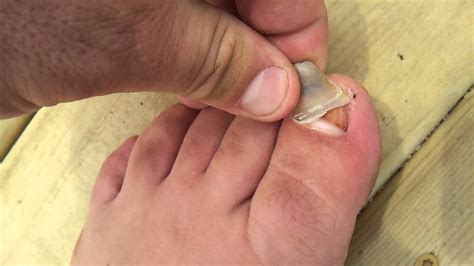 What does a dead toenail look like?