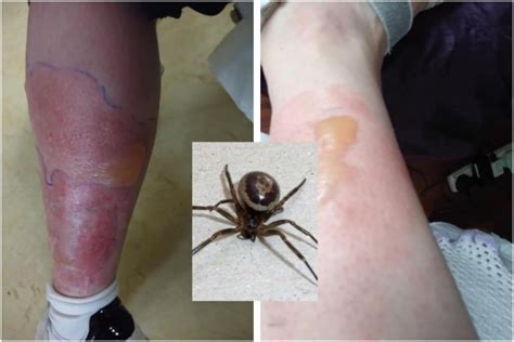 What does a false widow bite look like at first?