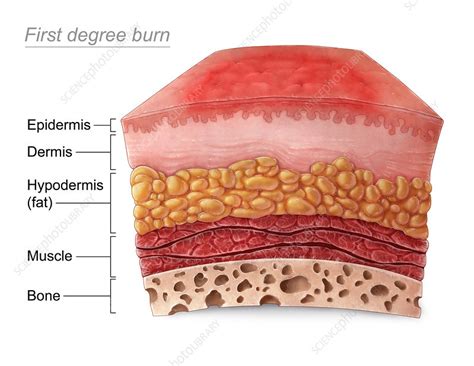 What does a first-degree burn look like?