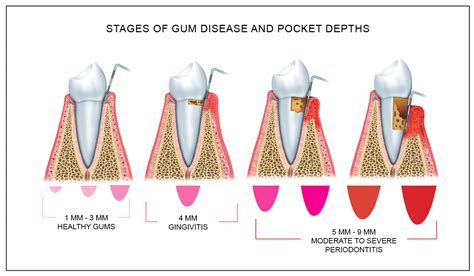 What does a gum score of 6 mean?