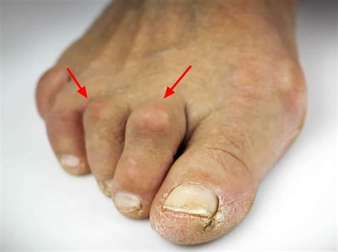 What does a hammer toe look like?