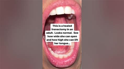 What does a healed frenectomy look like?