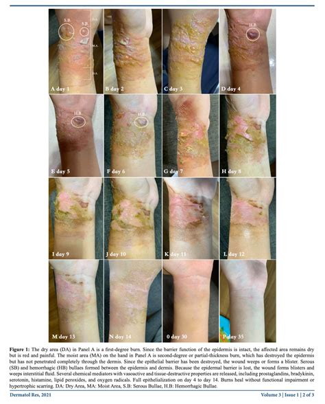 What does a healthy burn healing look like?