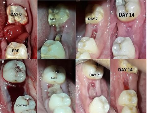 What does a healthy tooth extraction look like after 5 days?