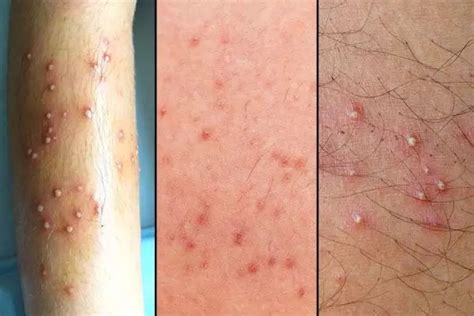 What does a mild case of folliculitis look like?