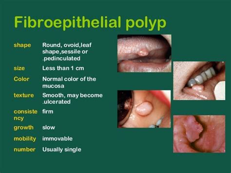 What does a mouth polyp look like?