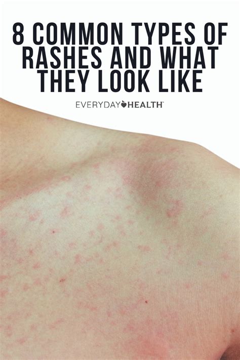 What does a normal rash look like?