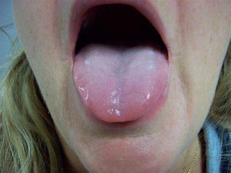 What does a normal size tongue look like?