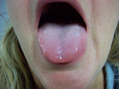 What does a normal tongue look like without a tongue-tie?