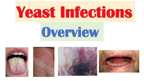 What does a severe yeast infection look like?