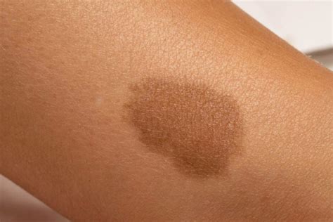 What does a starseed birthmark mean?